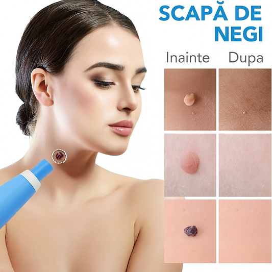 Dispozitiv pentru Îndepărtarea Negilor – Eliminare Fără Durere