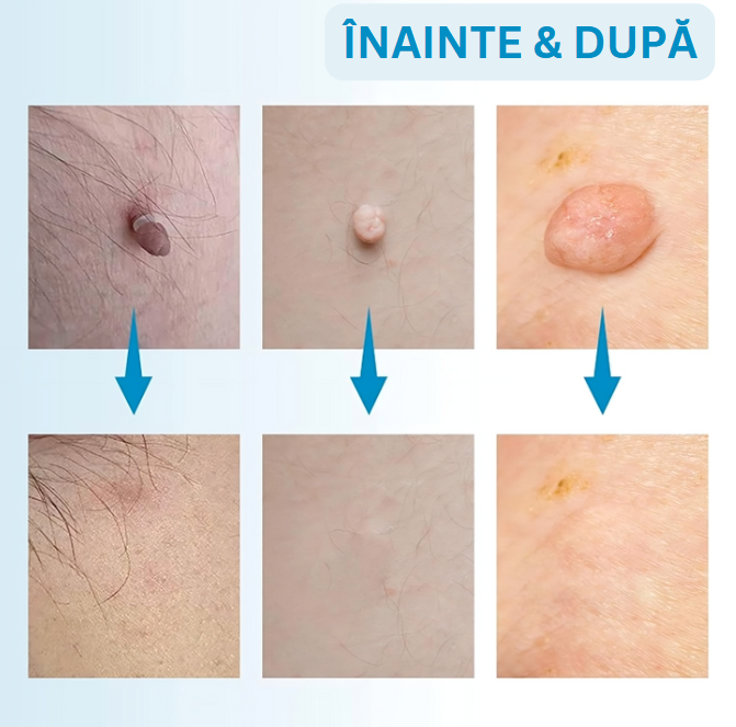 Dispozitiv pentru Îndepărtarea Negilor – Eliminare Fără Durere