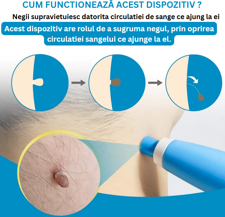 Dispozitiv pentru Îndepărtarea Negilor – Eliminare Fără Durere